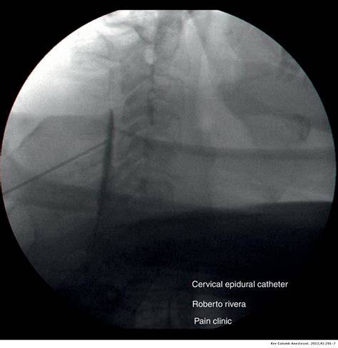 Radiografía de catéter epidural con contraste