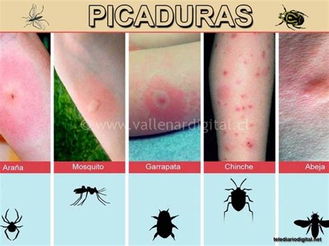 Tratamiento de picadura roja e hinchada