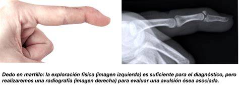 Lesión del dedo por pelota de béisbol