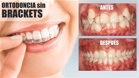 Alternativas de ortodoncia sin brackets