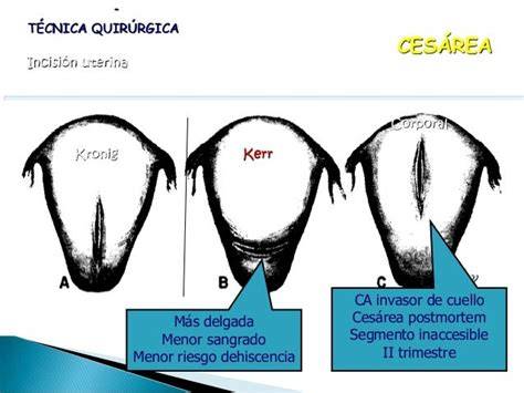 Cesárea: incisión abdominal y uterina