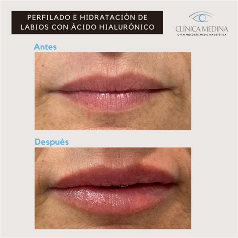 Labios partidos antes y después de hidratación