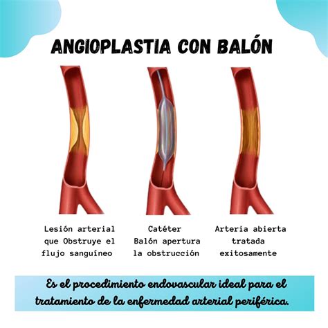 Angioplastia con balón en lesión bifurcada