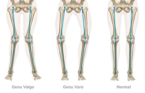 Desalineación de rodilla en varo y valgo