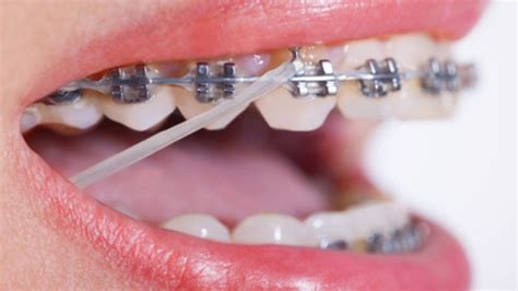 Colocación de ligas verticales en brackets
