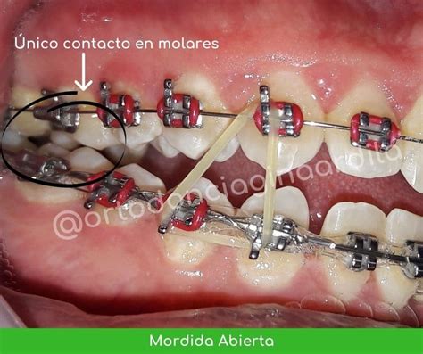 Esquema de ligas para mordida abierta