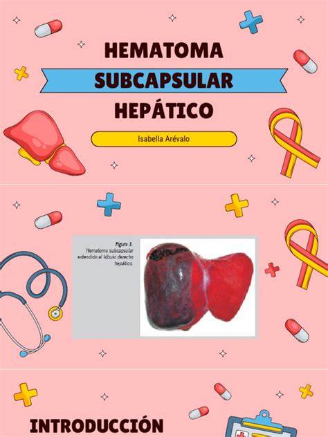 hematoma subcapsular hepático ilustración médica