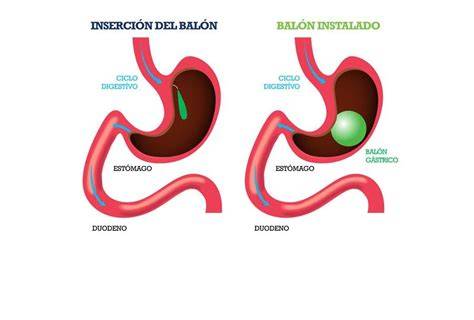 Funcionamiento del balón intragástrico