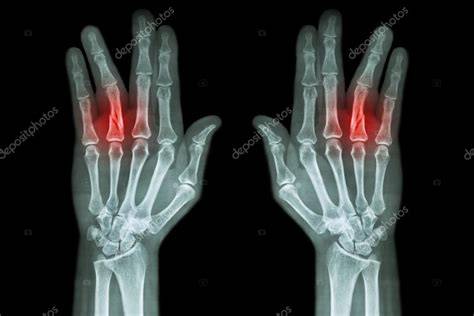 Radiografía falange proximal dedo anular