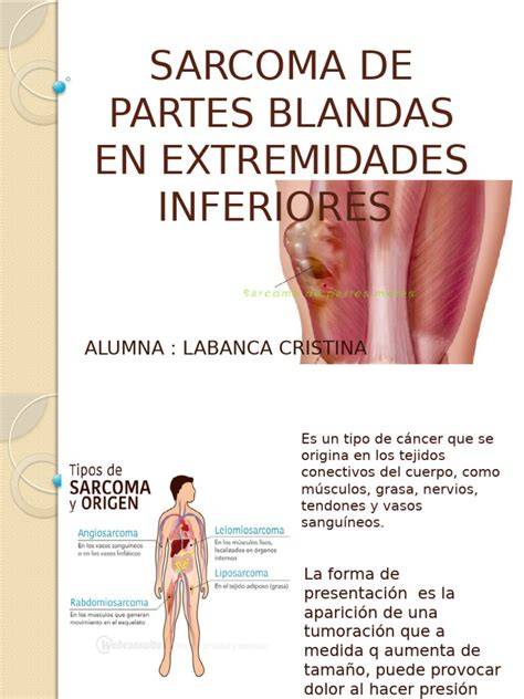Localización de sarcomas de partes blandas