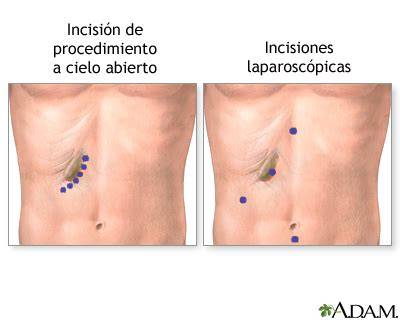 cuidados de incisión laparoscópica abdominal