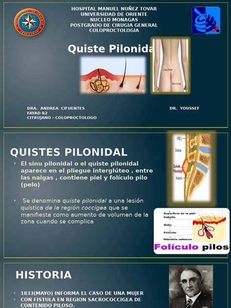 Quiste pilonidal en pliegue interglúteo