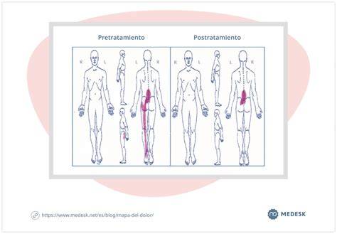 Mapa del dolor pélvico femenino