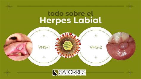 Etapas iniciales del herpes simple