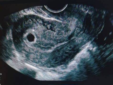 Ecografía transvaginal del primer trimestre