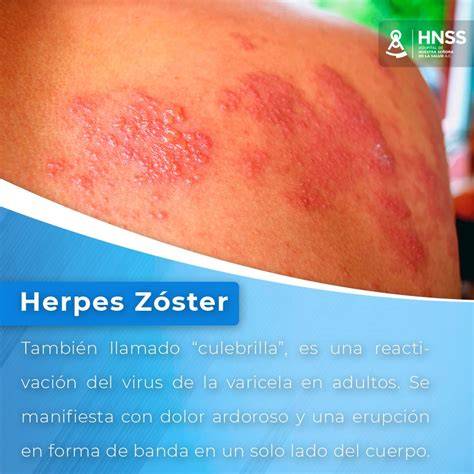 Erupción de herpes zóster en banda unilateral