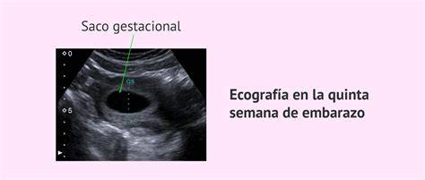 Ecografía transvaginal del embrión temprano
