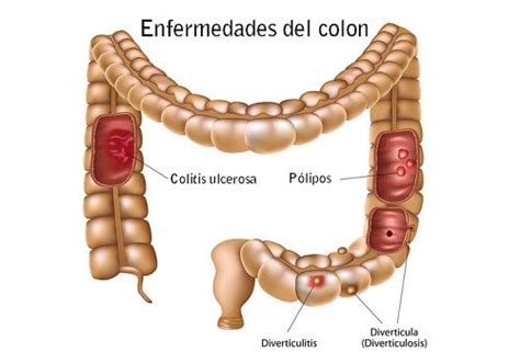 Comparación de enfermedades del colon