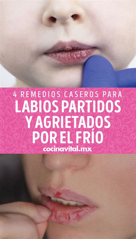 Labios partidos por frío y viento